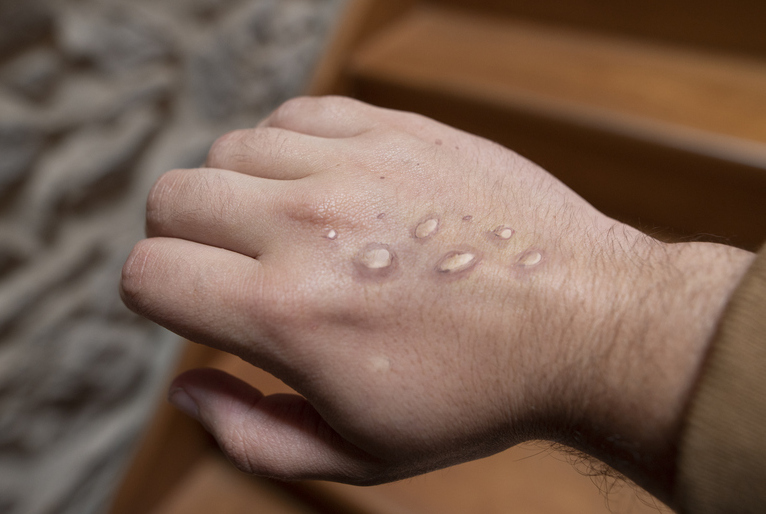 Mais três casos suspeitos de varíola dos macacos são notificados no Amazonas