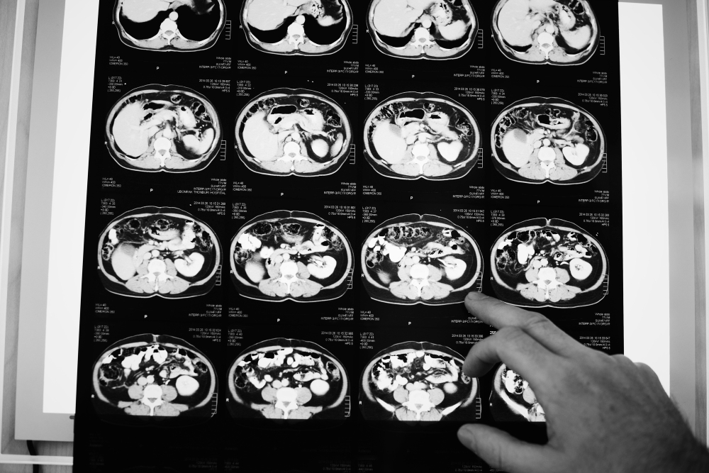 Anvisa aprova novo medicamento para câncer colorretal metastático
