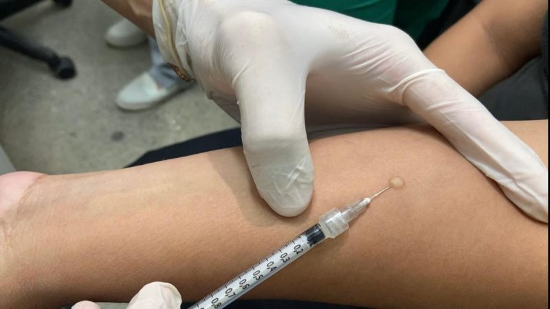 Prefeitura de Manaus amplia oferta do teste tuberculínico para 55 unidades de saúde na capital